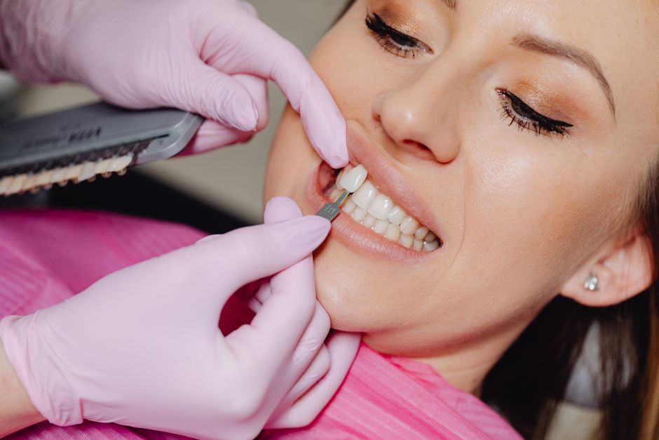 ابتسامة بعد تجميل الأسنان